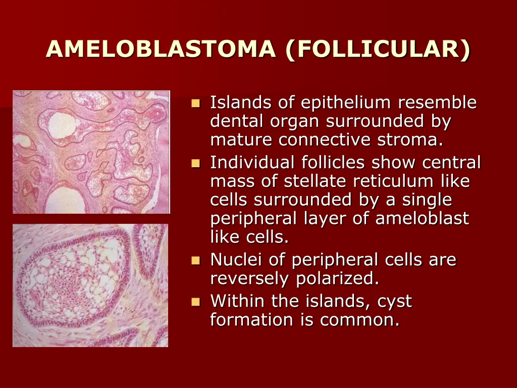 ameloblastoma follicular