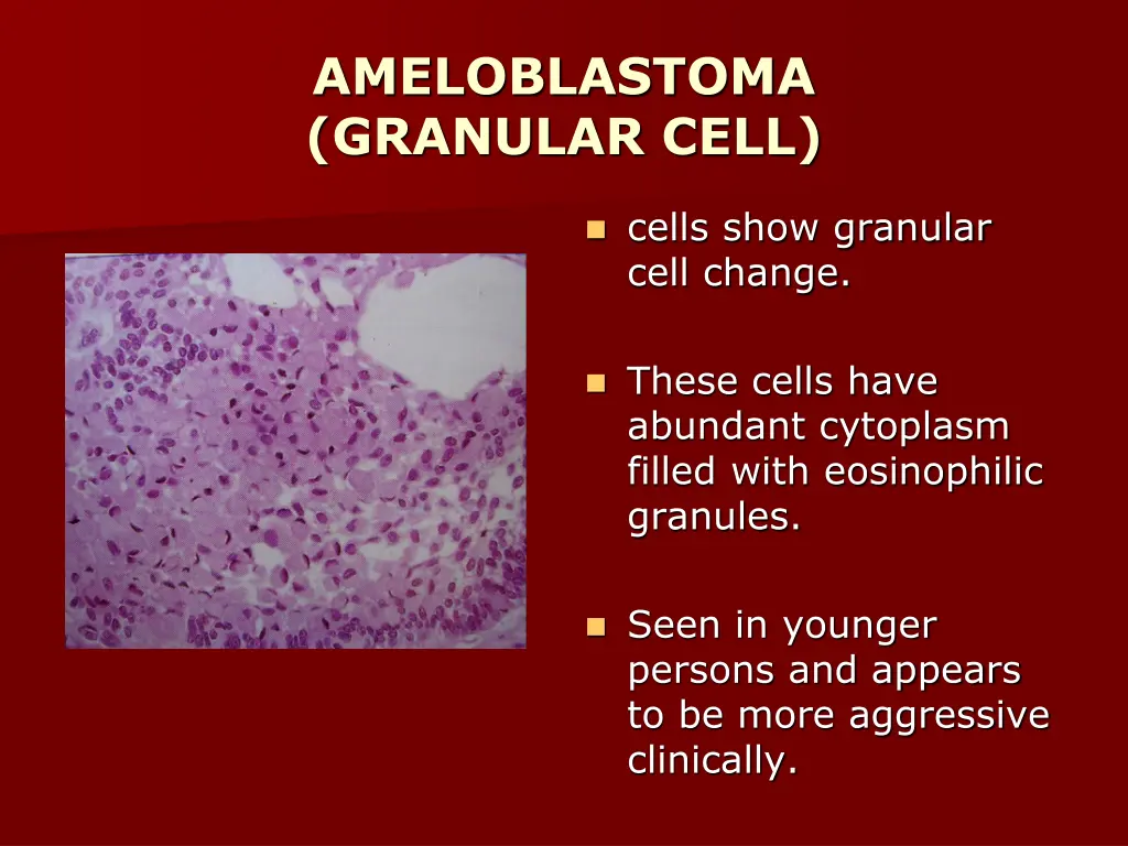 ameloblastoma granular cell