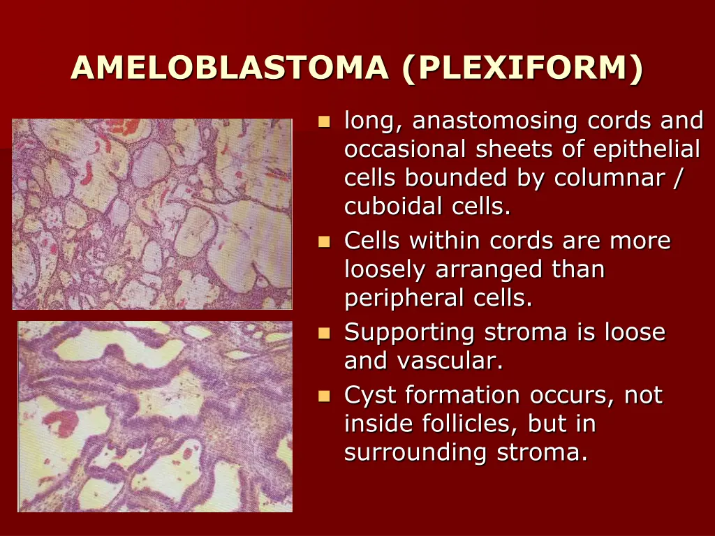 ameloblastoma plexiform