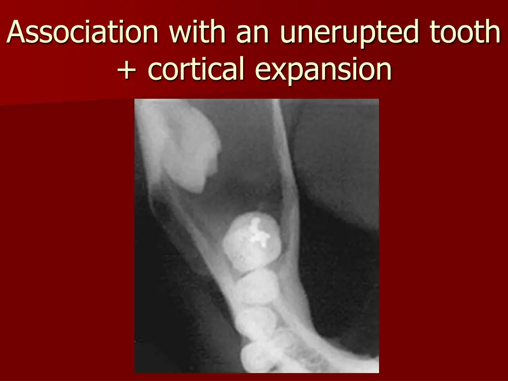 association with an unerupted tooth cortical