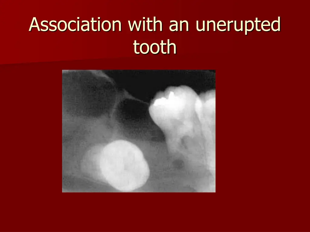 association with an unerupted tooth