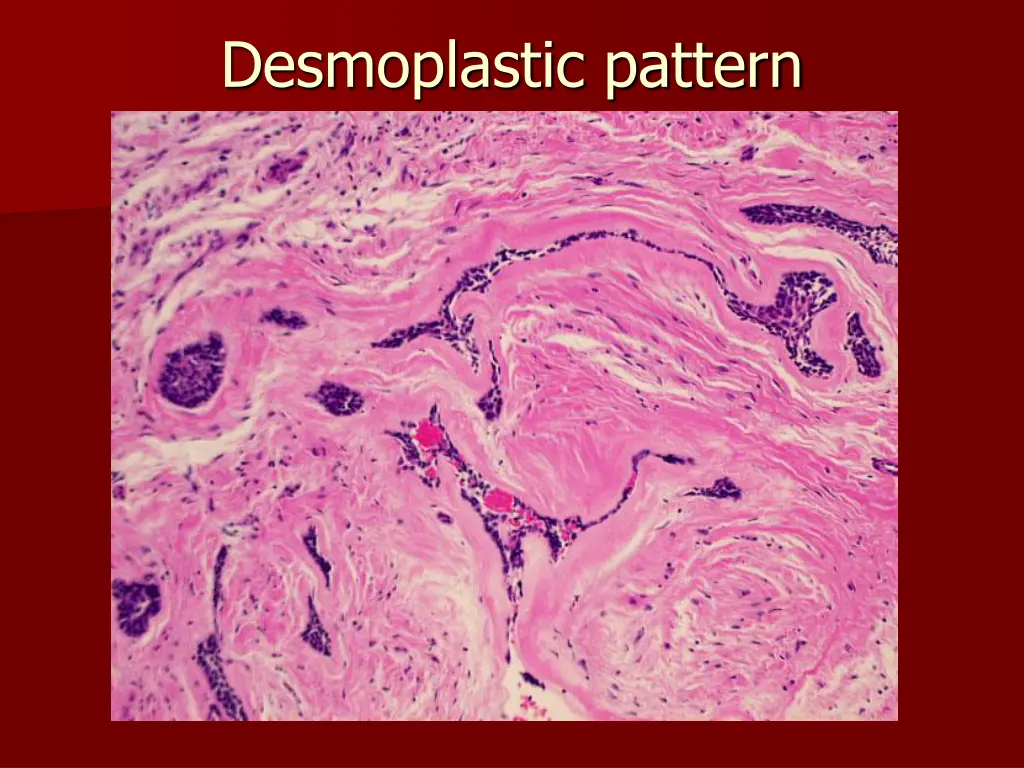 desmoplastic pattern