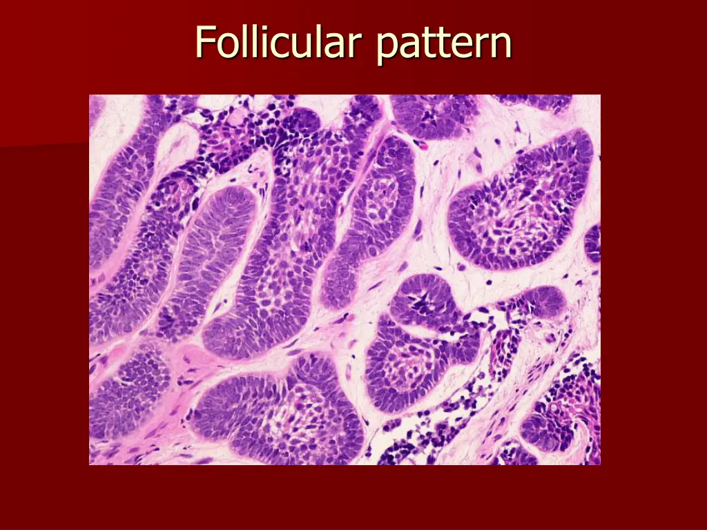 follicular pattern