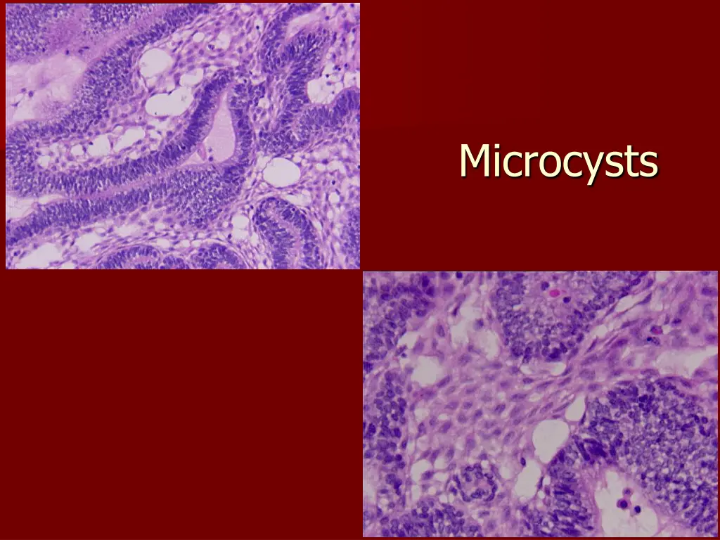 microcysts