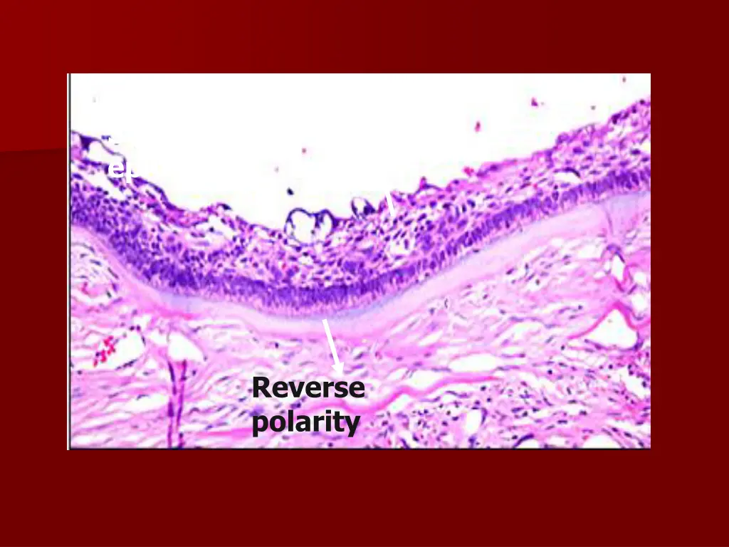 stellate reticulum like epithelium