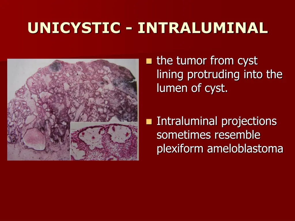 unicystic intraluminal