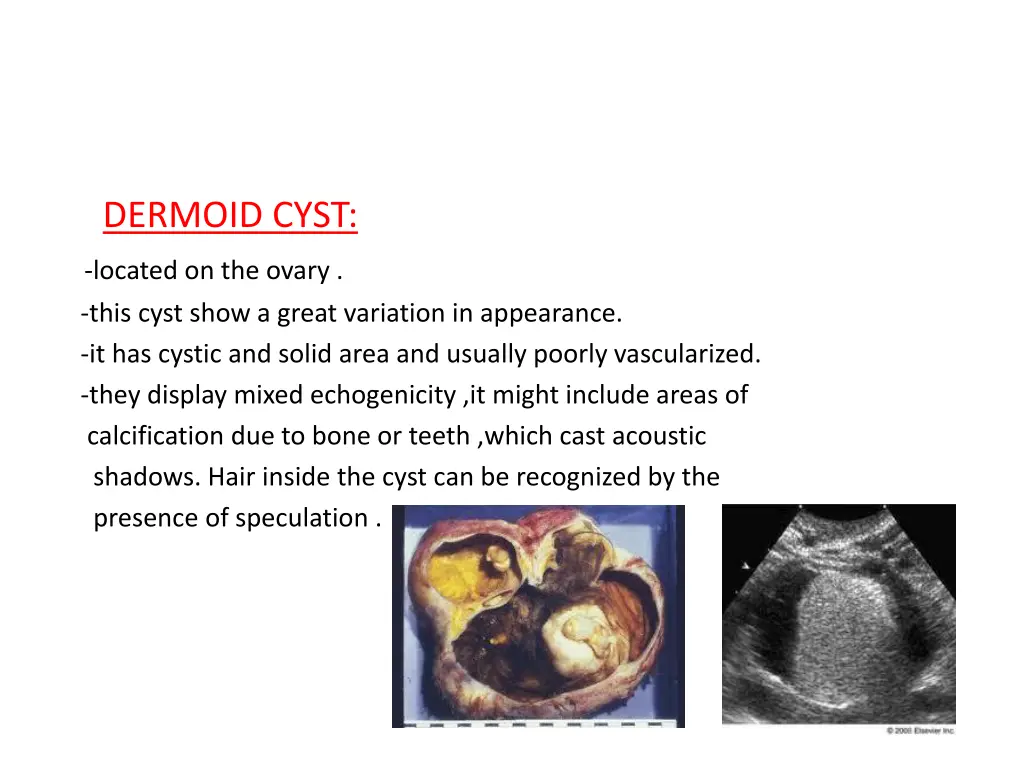 dermoid cyst