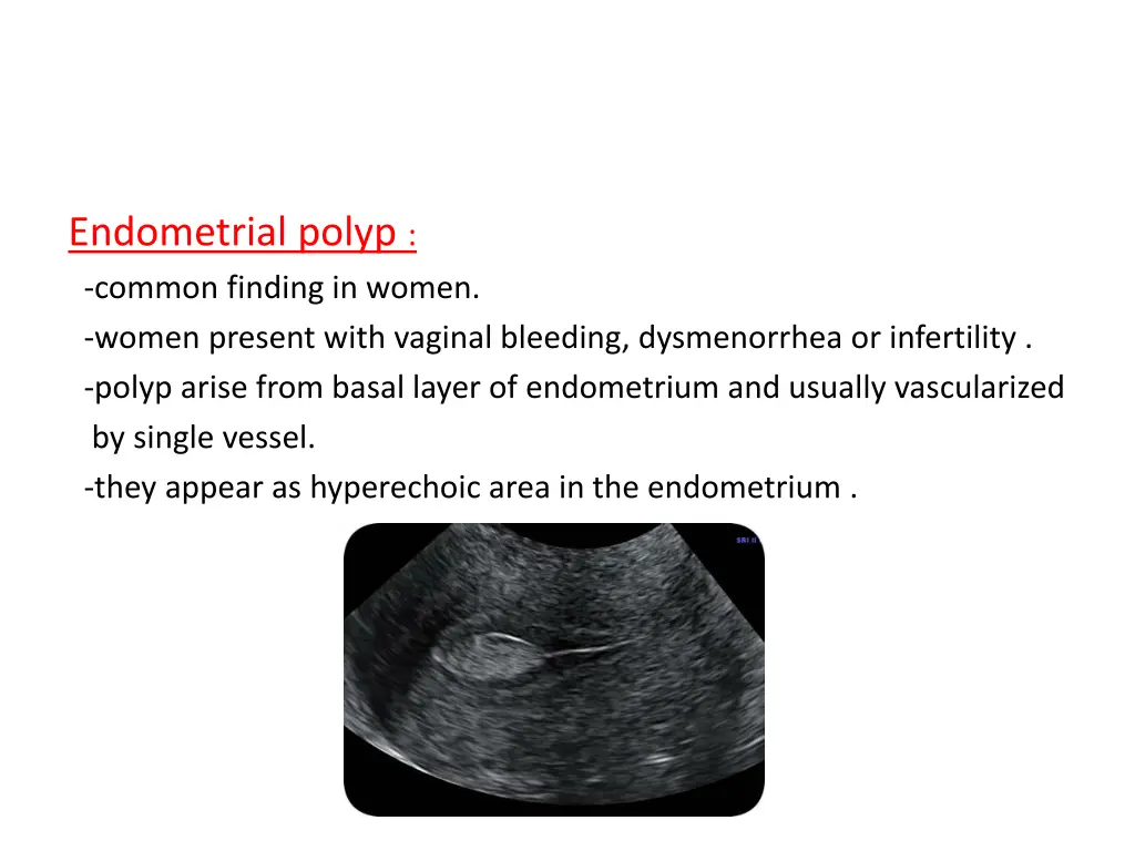 endometrial polyp common finding in women women