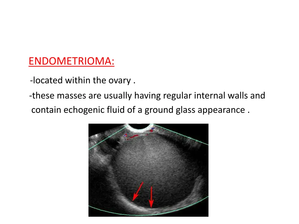 endometrioma