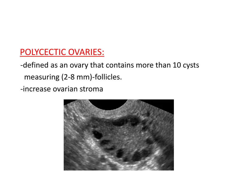 polycectic ovaries defined as an ovary that
