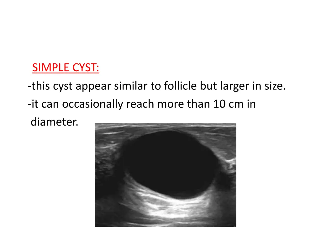 simple cyst this cyst appear similar to follicle