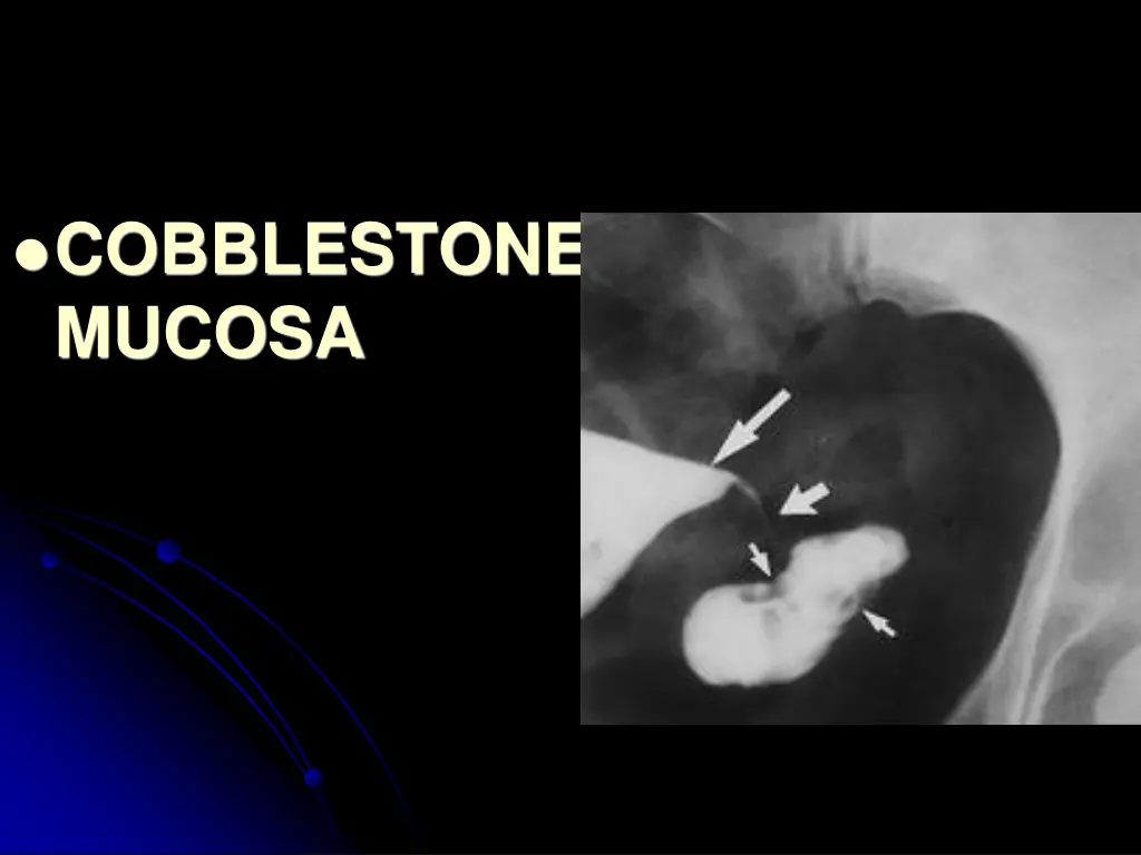 cobblestone mucosa