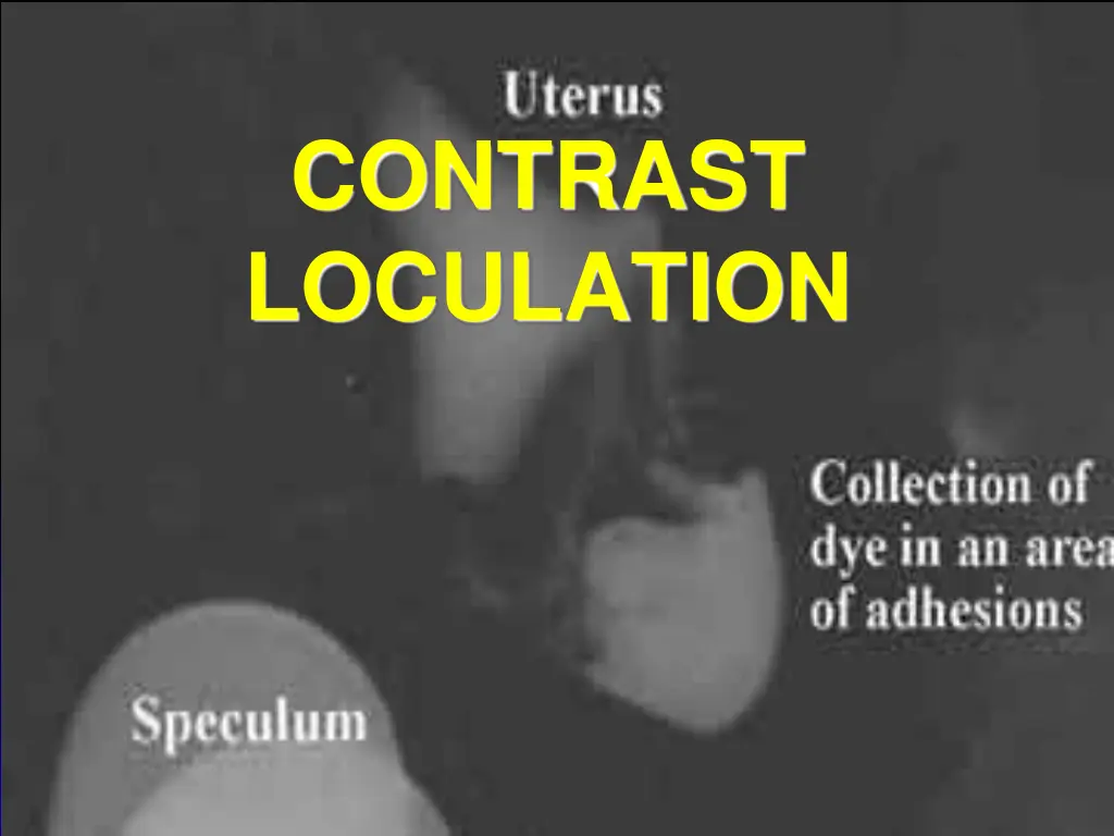 contrast loculation