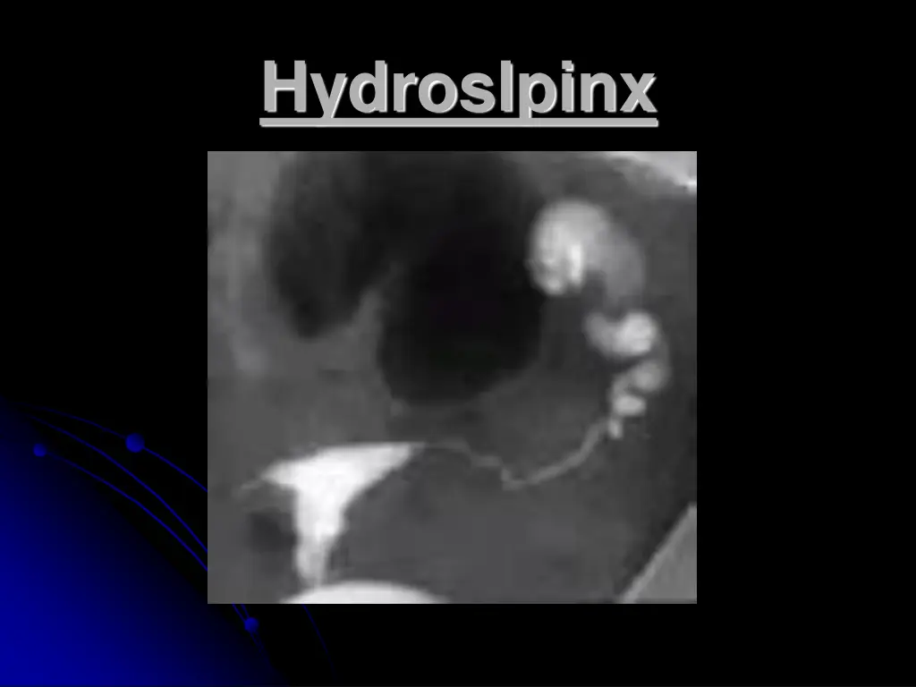 hydrosalpinx hydroslpinx