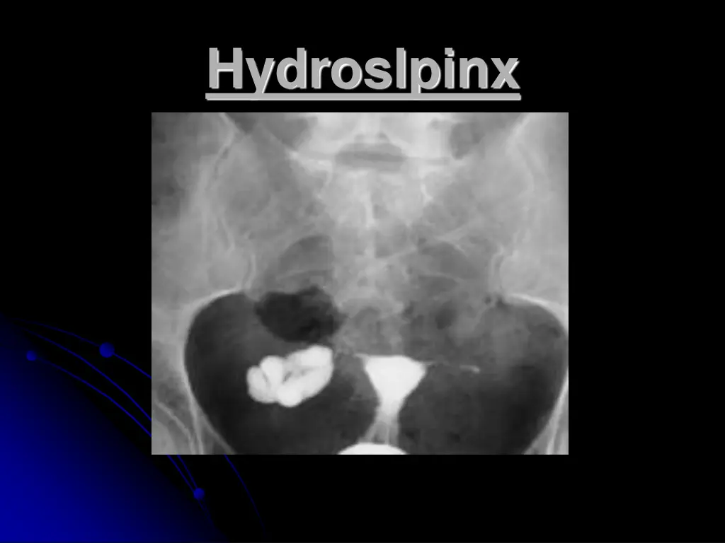 hydroslpinx
