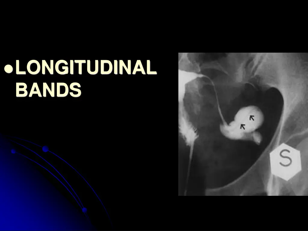 longitudinal bands