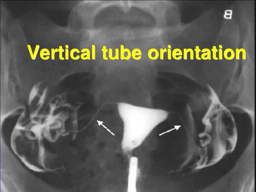 vertical tube orientation