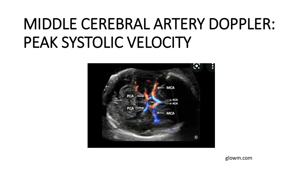 middle cerebral artery doppler middle cerebral