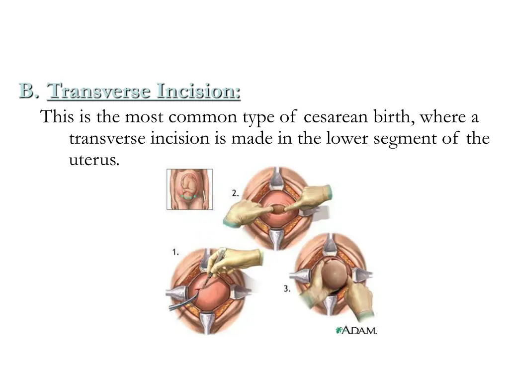 b transverse incision this is the most common