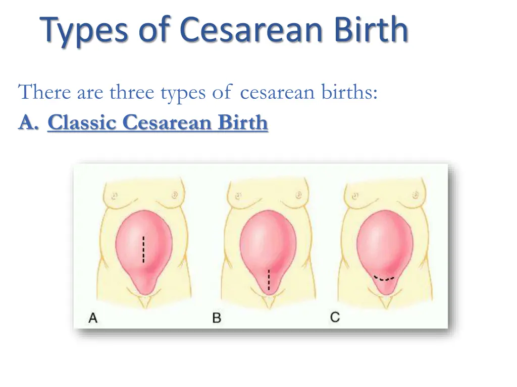 types of cesarean birth