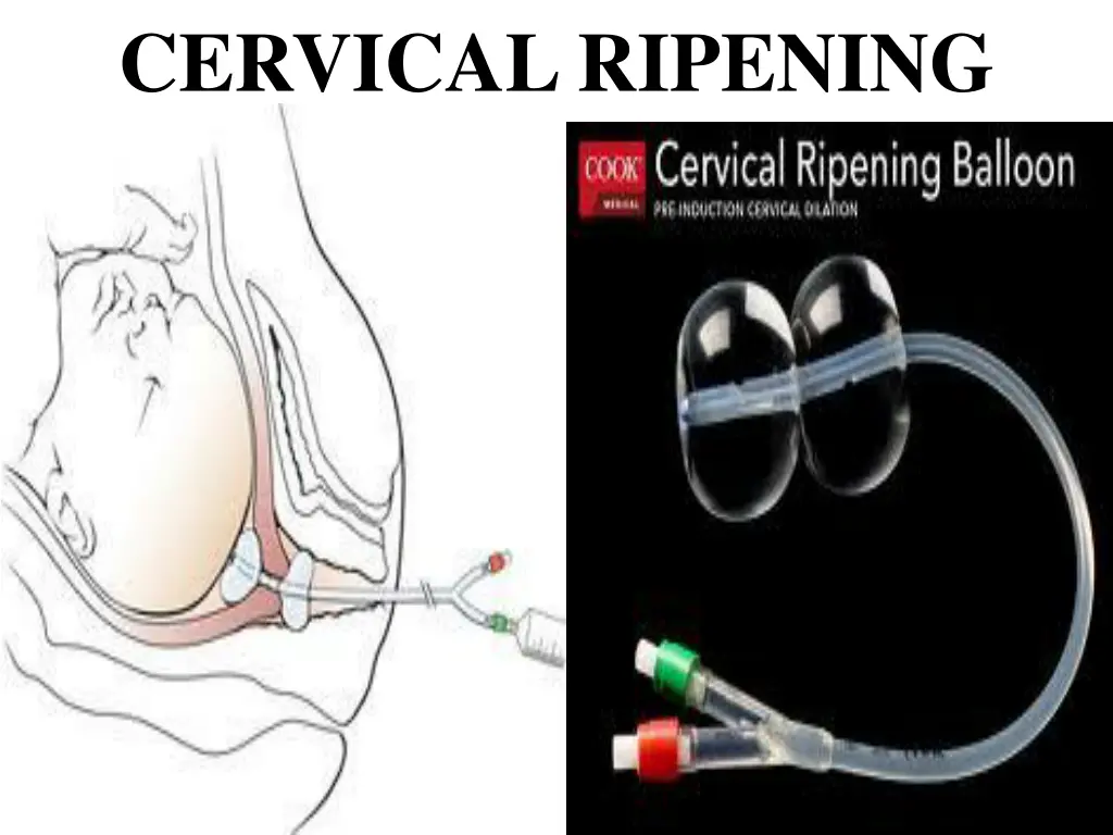 cervical ripening