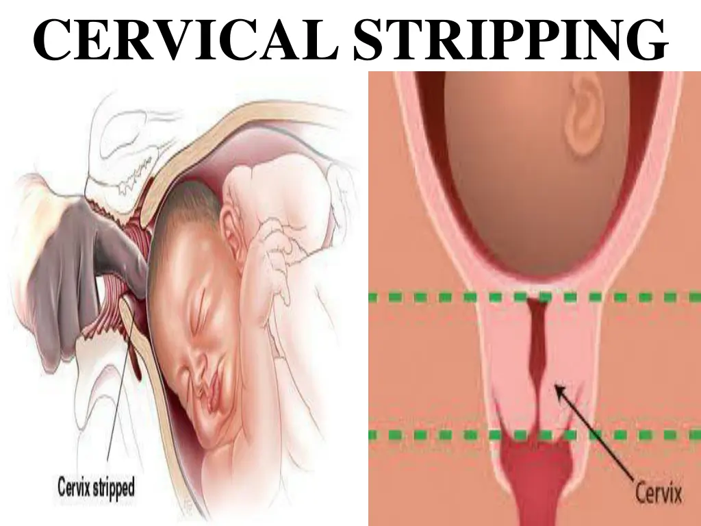 cervical stripping