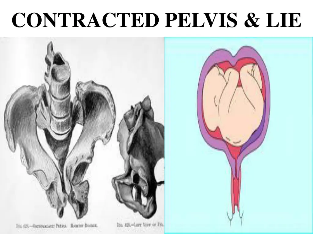 contracted pelvis lie