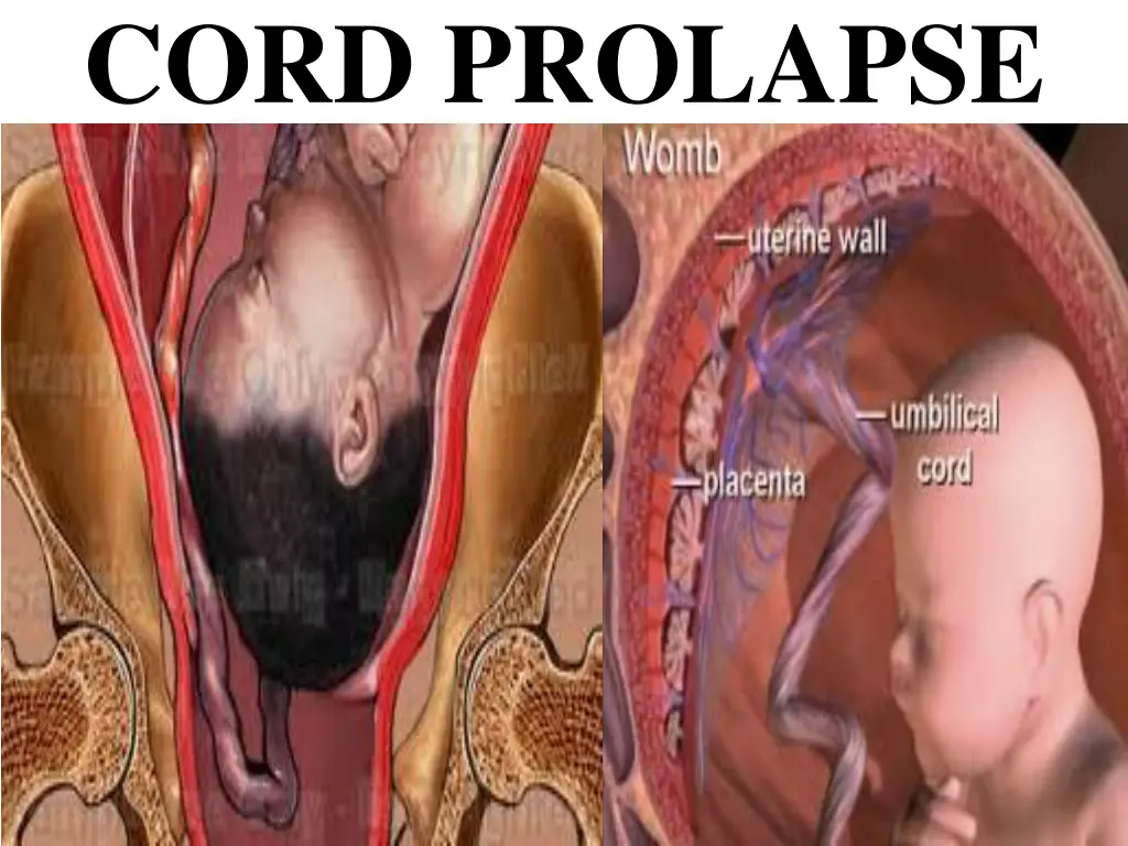 cord prolapse