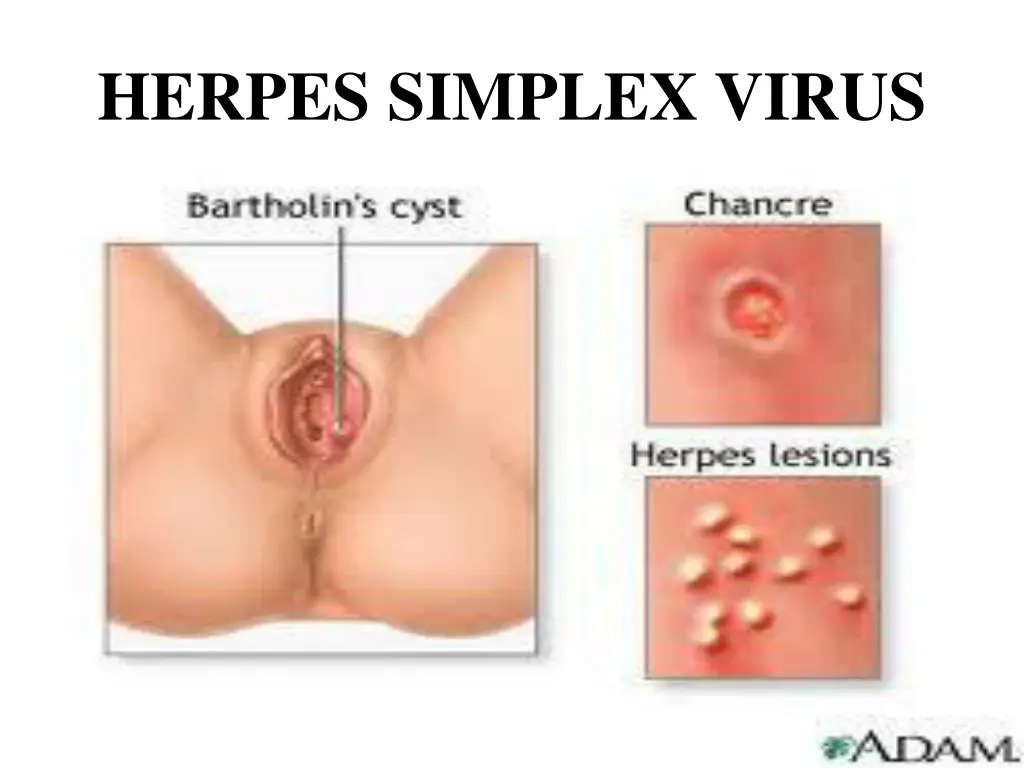 herpes simplex virus
