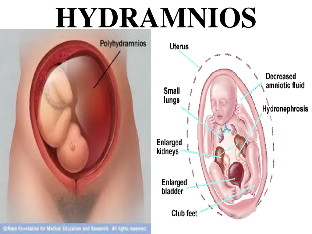 hydramnios