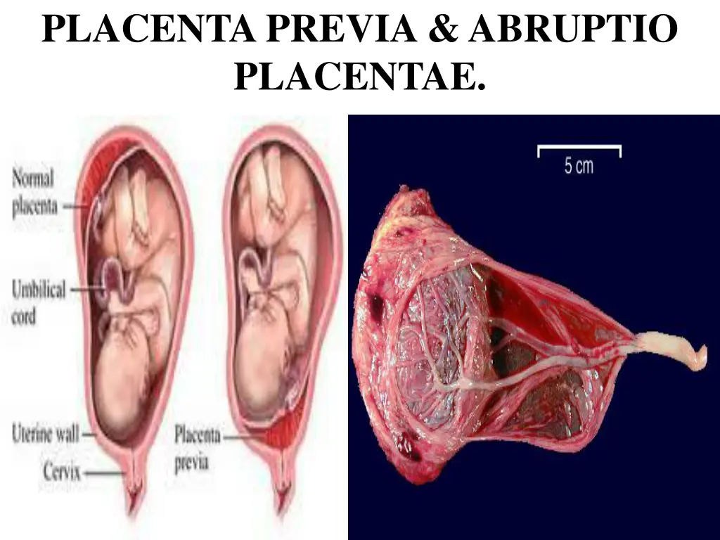 placenta previa abruptio placentae