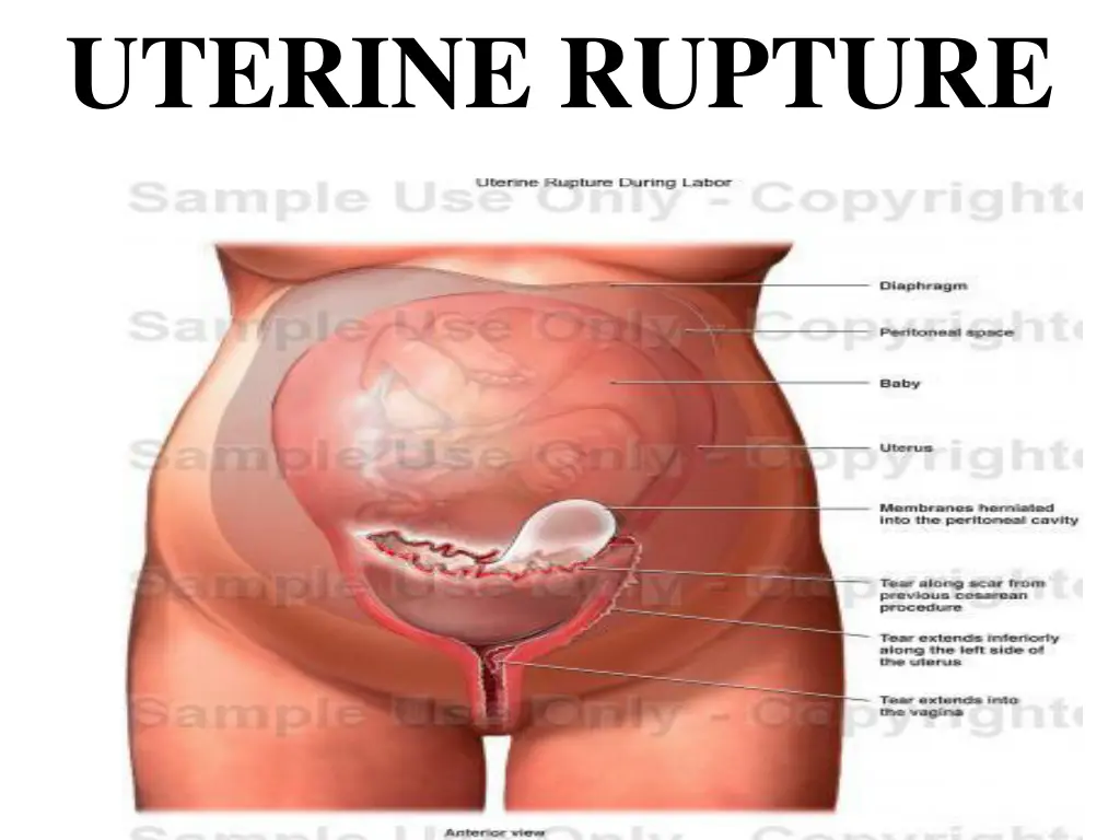 uterine rupture