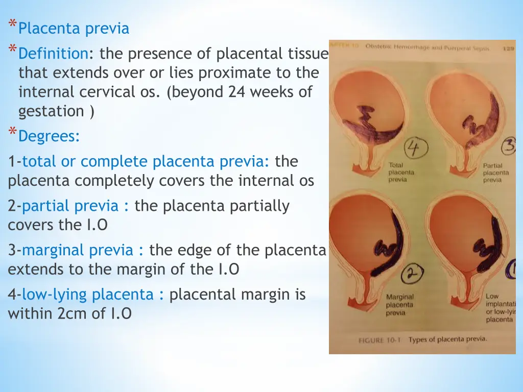 placenta previa definition the presence