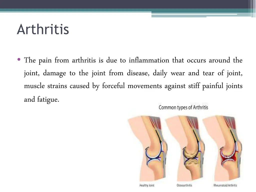 arthritis 2