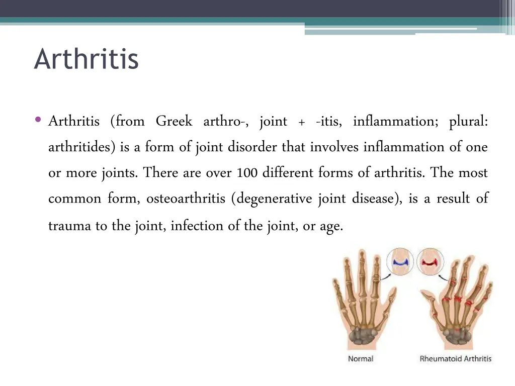 arthritis