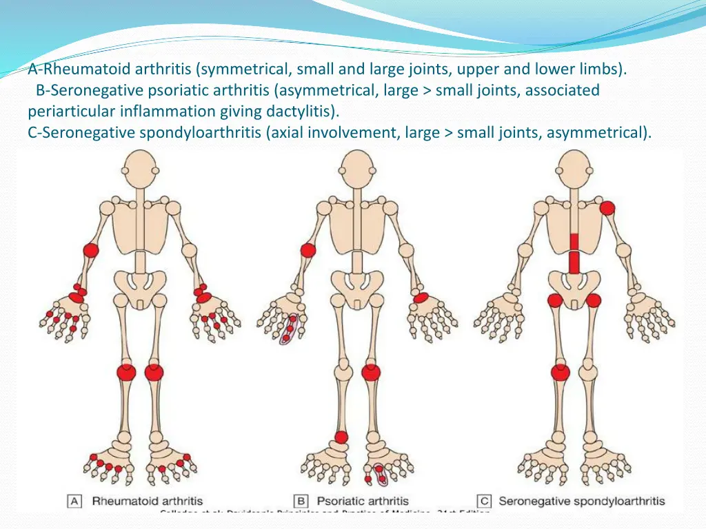 a rheumatoid arthritis symmetrical small