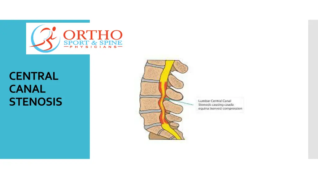 central canal stenosis