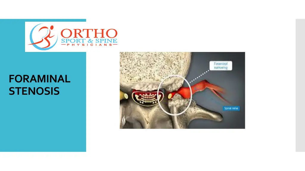 foraminal stenosis