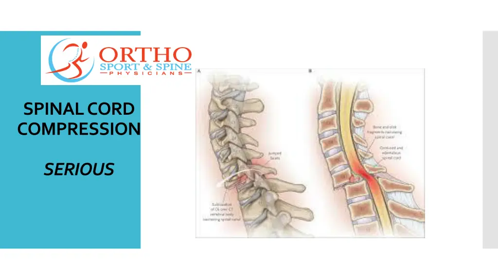 spinal cord compression