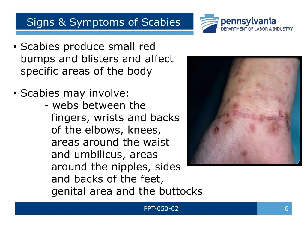 signs symptoms of scabies