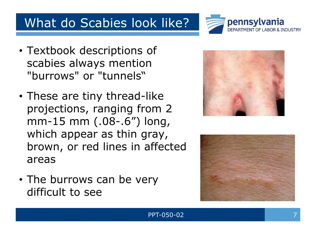 what do scabies look like