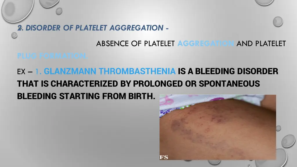 2 disorder of platelet aggregation