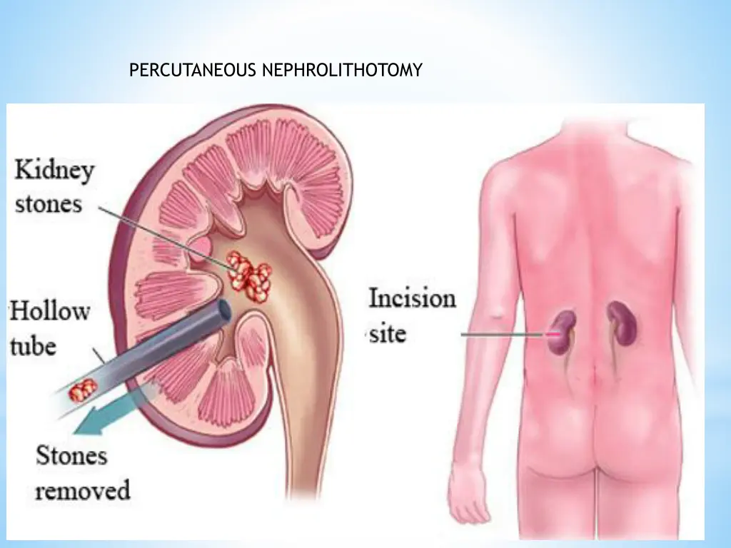 percutaneous nephrolithotomy