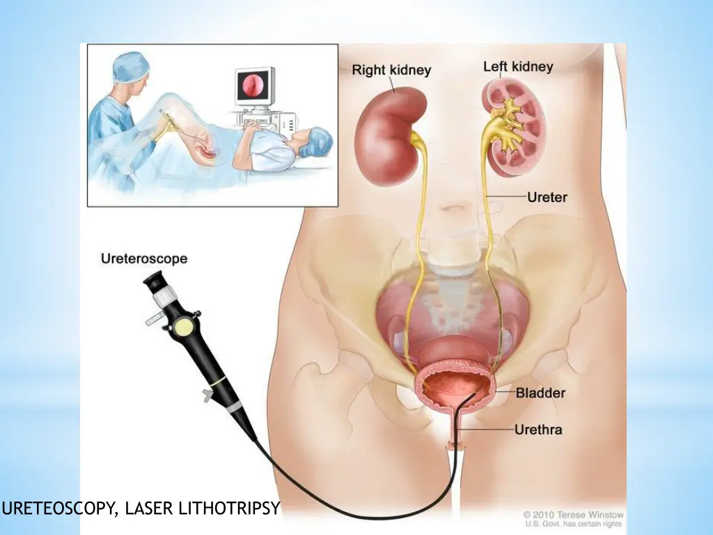 ureteoscopy laser lithotripsy