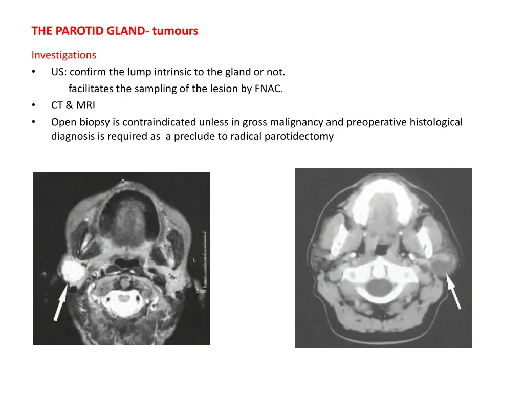the parotid gland tumours 2