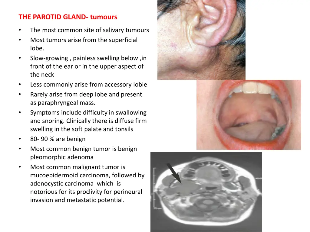 the parotid gland tumours
