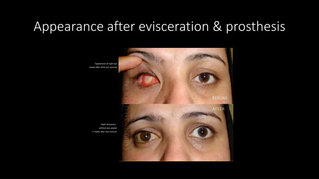 appearance after evisceration prosthesis 1