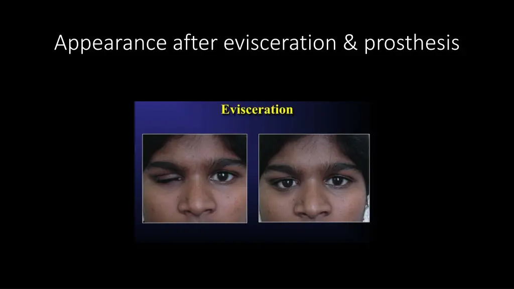 appearance after evisceration prosthesis
