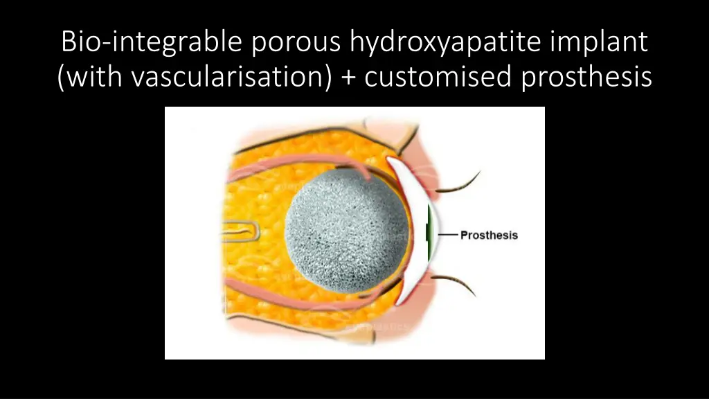bio integrable porous hydroxyapatite implant with