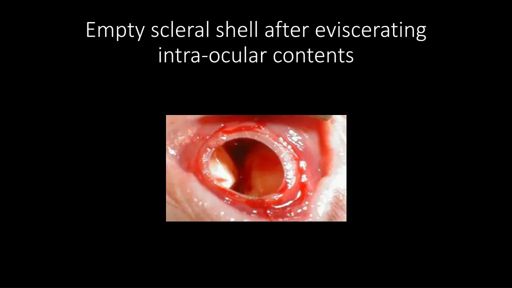empty scleral shell after eviscerating intra